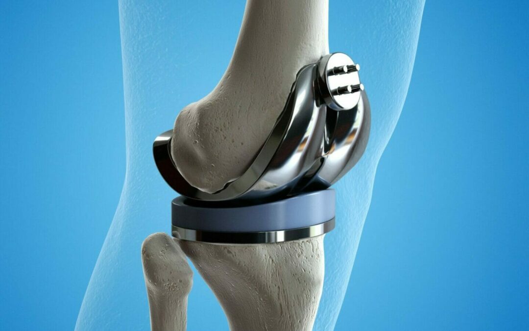 What exercises should I do immediately after my Knee Replacement?