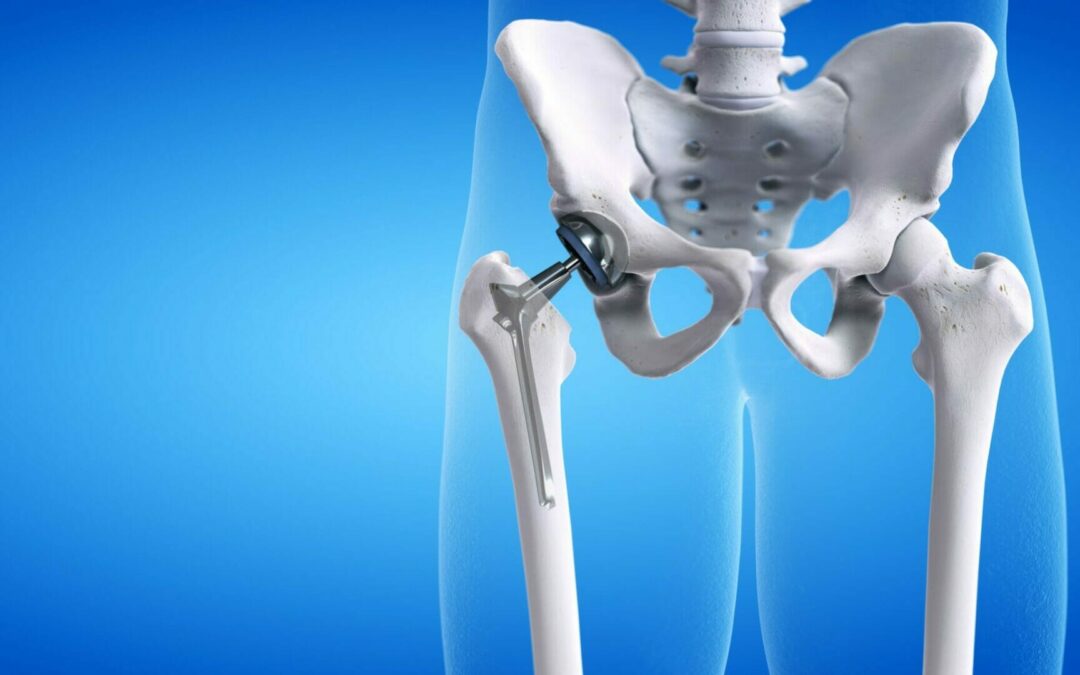 Total Hip Replacement – rehab exercises