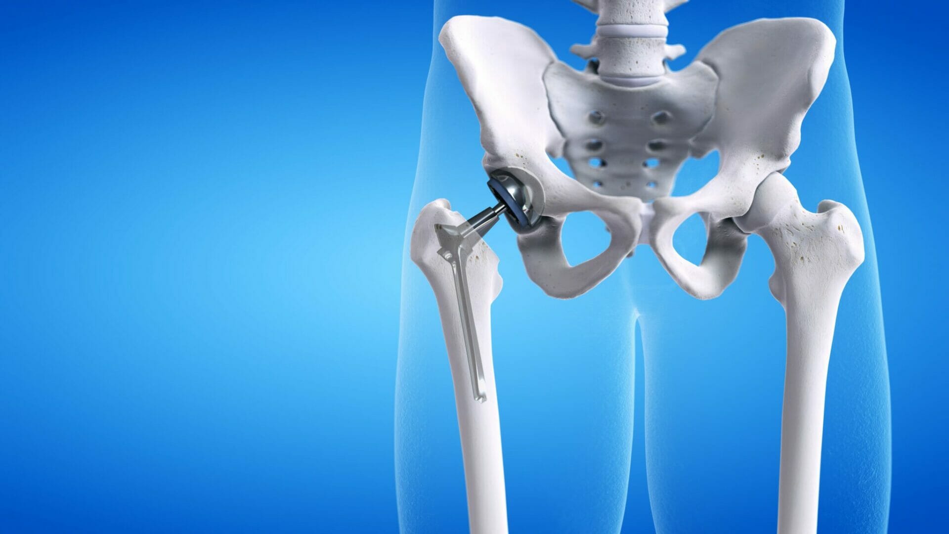 Total Hip Replacement – rehab exercises | Physio-logical