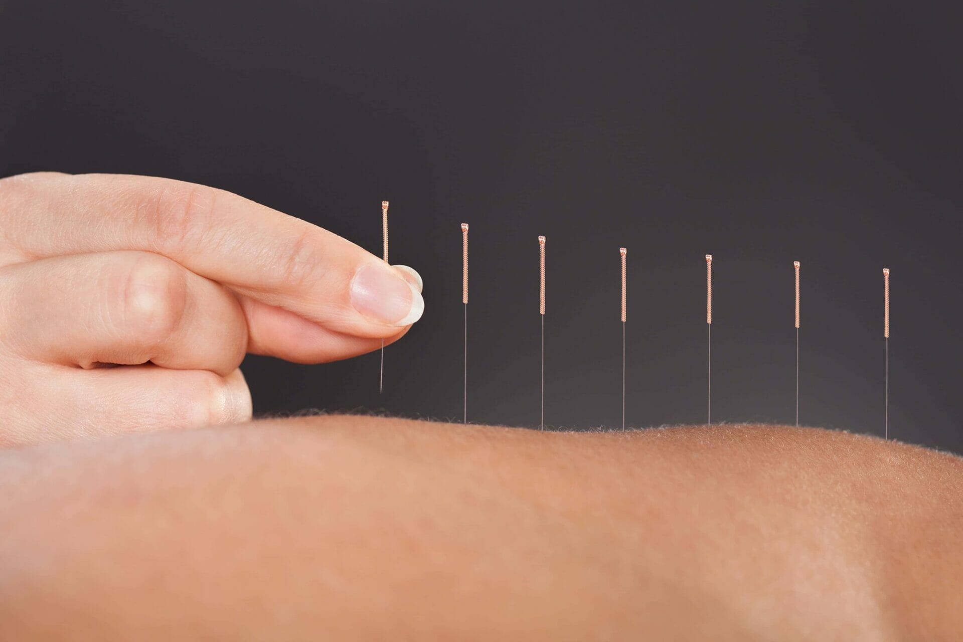 Acupuncture Emsworth Physio Logical