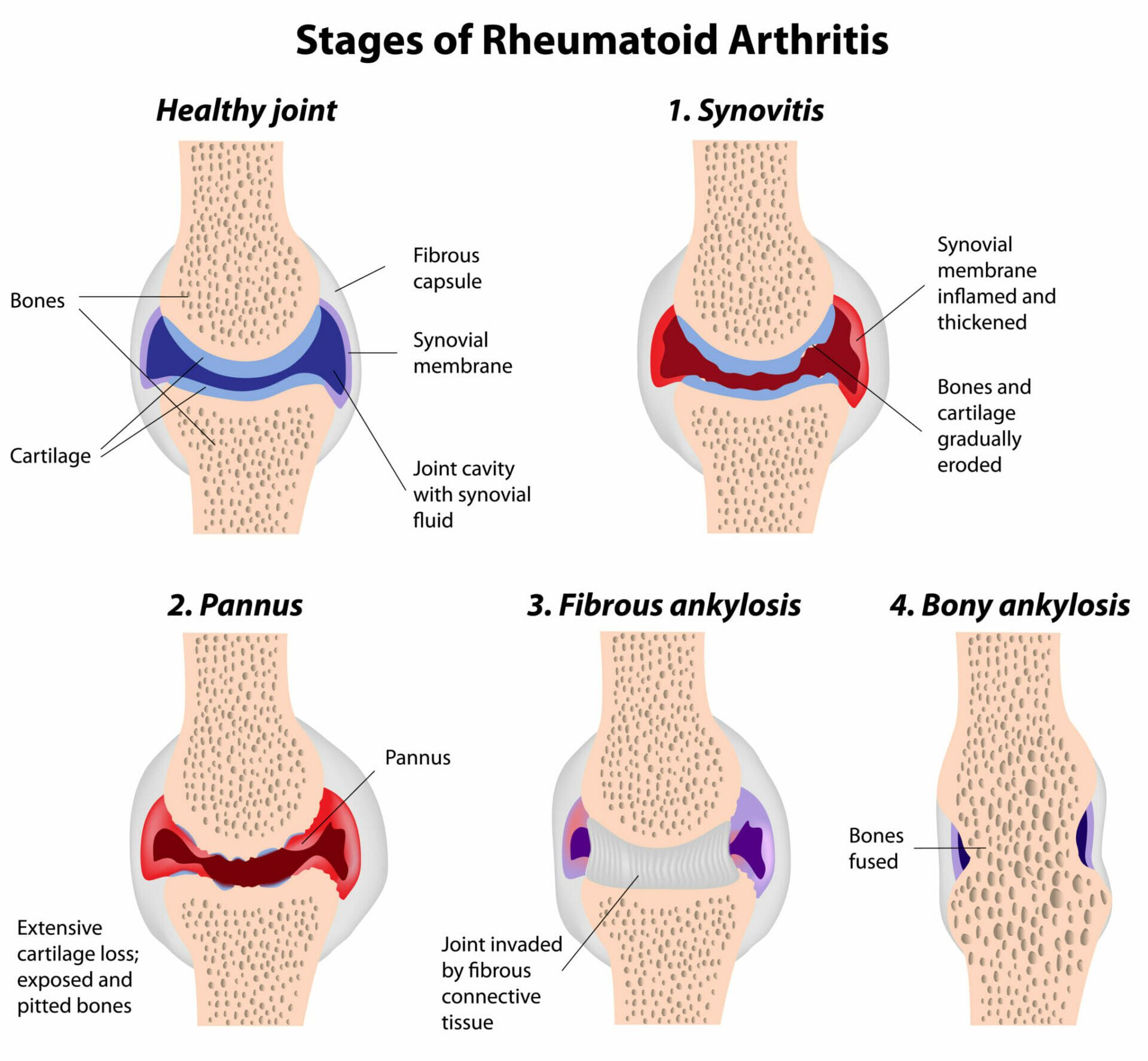 Лечение артрита суставов в домашних условиях. Ревматоидный артрит классификация коленный сустав. Ревматоидный паннус микропрепарат.