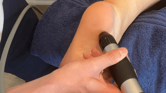 Treating Plantar Fasciitis with Radial Shockwave Therapy